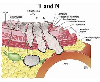 medical letter acronyms 3 TNM What is